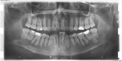 Pano 1 mu9gri - Eugenol