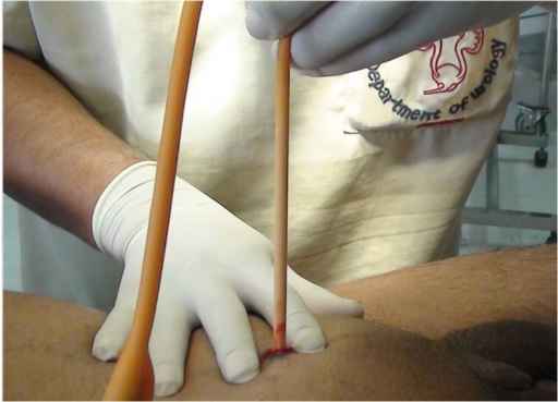 Kateter Suprapubik Sumber: Openi 2012