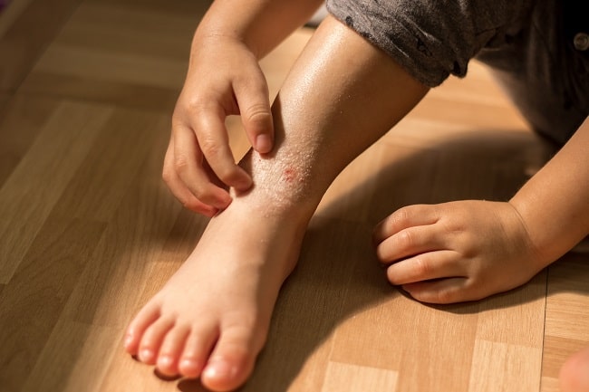 Pedoman Tatalaksana Terbaru Psoriasis Pediatrik-min