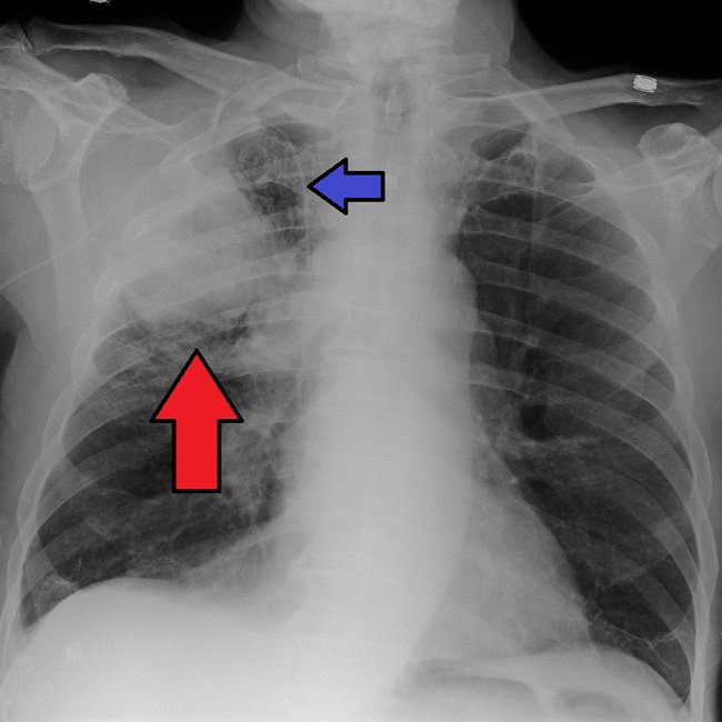 Sumber: Heilman J, Wikimedia commons, 2016.