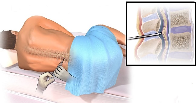 ambil darah arteri, pengambilan darah arteri, cara mengambil darah arteri, alomedika