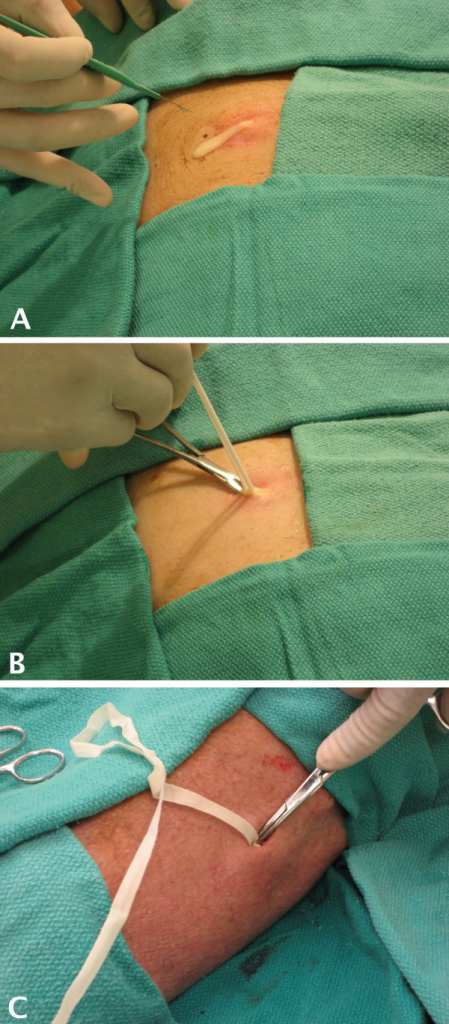 Insisi-drainase-packing abses. Sumber: anonim, Openi, 2008.