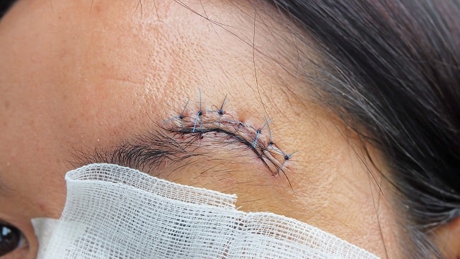 penggunaan antibiotik pada trauma wajah