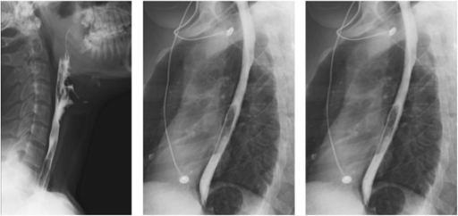 Barium swallow fluoroscopy test. Sumber: anonim, Openi, 2015.