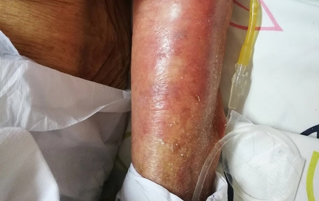 Siklosporin untuk Sindroma Stevens Johnson (SJS) dan Toxic Epidermal Necrolysis (TEN)-min (1)