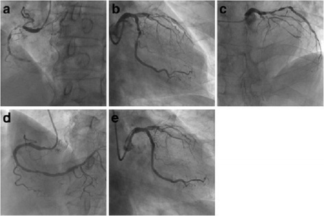 Gambar 1. Angiografi dan PCI pada arteri koroner kanan dan arteri sirkumfleks kiri. (Sumber : Openi, 2016)