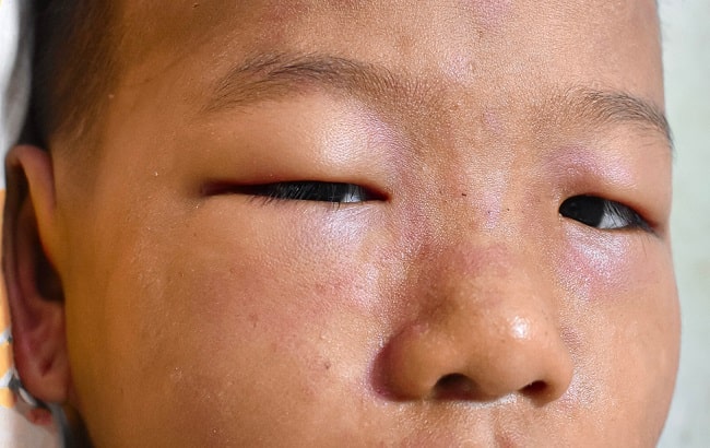 Pemberian Profilaksis Antikoagulan pada Pasien Sindrom Nefrotik-min