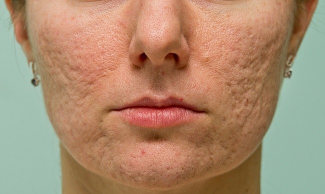 Atrophic Acne Scar comp