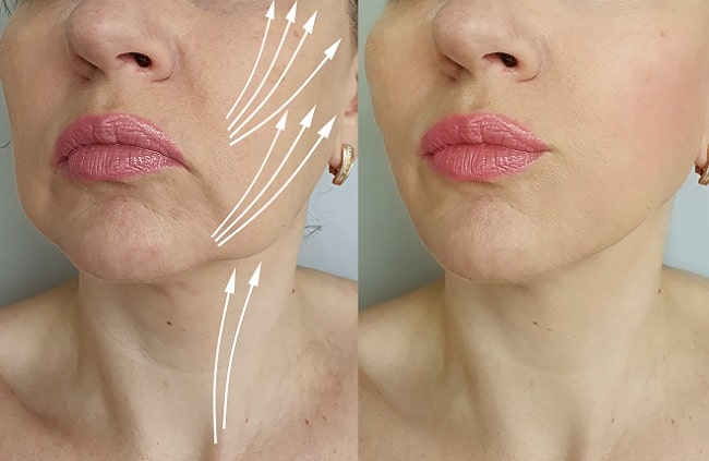 Manfaat dan Profil Risiko Stem Cell Facelift-min