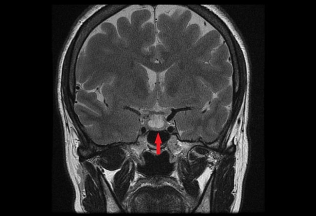 Luaran Prolaktinoma Setelah Kehamilan dan Laktasi-min