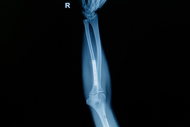 Film x-ray forearm fracture : show fracture ulnar bone with inse
