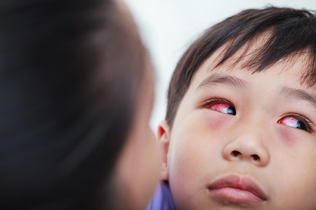Pemeriksaan Klinis Konjungtivitis Viral vs Bakterial-min