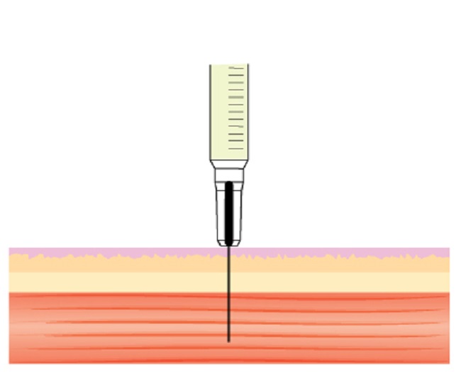 Different,Methods,For,Injecting,The,Skin,And,The,Muscle,,Showing