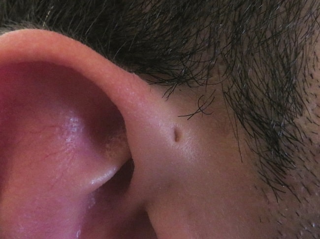 Preauricular_sinus-min