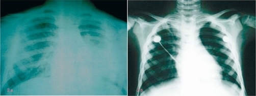 X-ray Croup pra-paska bronkoskopi. Sumber: anonim, Openi, 2009.