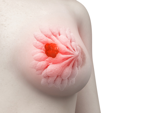 breast tumor comp