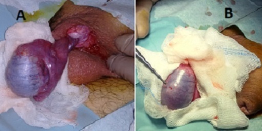 Torsio testis rekuren paska orkidopeksi