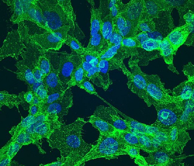 Gambar 1. Sel Fibrosarkoma (Sumber: Balapagos, Wikimedia Commons, 2009)