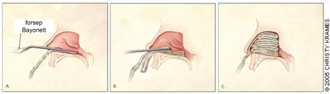 gambar 3 tampon hidung