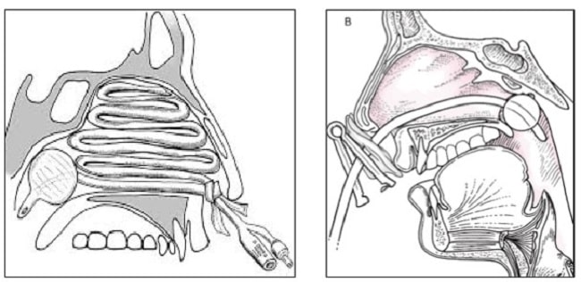 gambar 4 tampon hidung-min