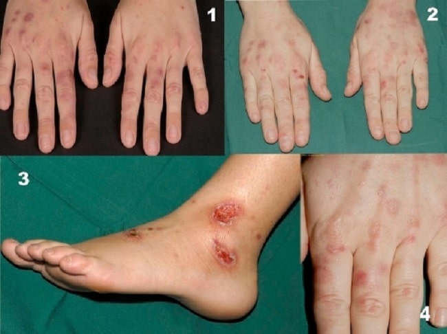 Sumber Gambar: Openi, 2009.