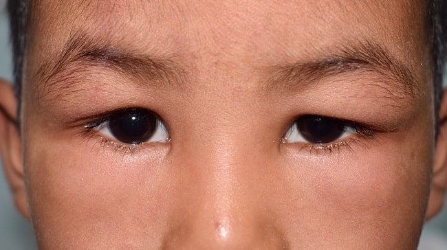 Penggunaan Kortikosteroid untuk Sindrom Nefrotik pada Anak-min