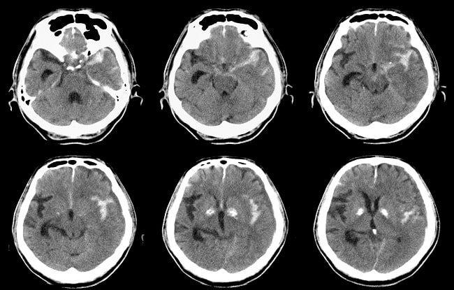 Perdarahan Subaraknoid Spontan-min