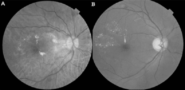 Brolucizumab dalam Tata Laksana Diabetic Macular Edema (DME)-min (1)