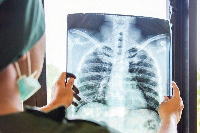 rontgen toraks, rontgen thorax, ronsen toraks, ronsen thorax, cara interpretasi rontgen toraks, cara interpretasi ronsen thorax, cara interpretasi rontgen thorax, cara interpretasi rontgen toraks, x-ray thorax, x-ray toraks, xray, xray toraks, xray thorax, alomedika