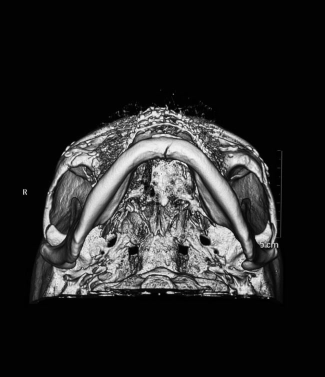 Manifestasi Klinis dan Pilihan Terapi pada Fraktur Basis Cranii-min