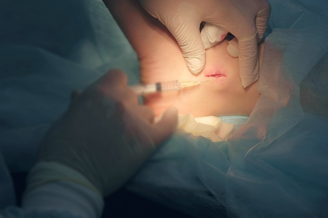 Surgeon,Man,Inputting,Drug,For,Local,Anesthesia,During,Surgery,To