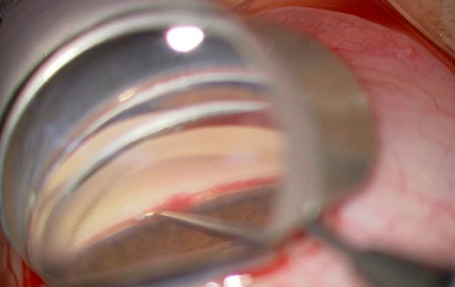 trabekulotomi, glaukoma, peningkatan tio, operasi glaukoma, trabeculotomy, alomedika