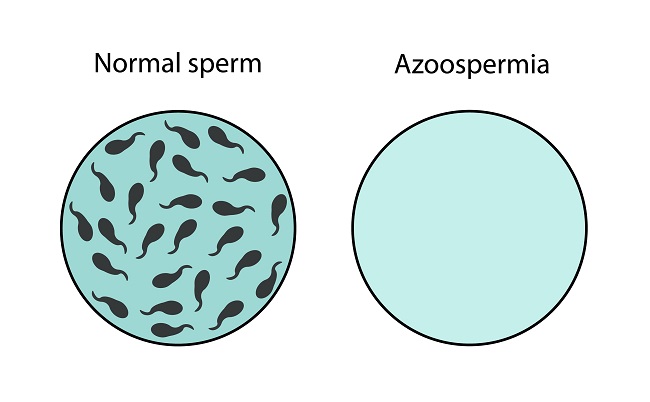 Semen,Analysis,,Normal,Sperm,And,Azoospermia.,Male,Reproductive,System,Concept.