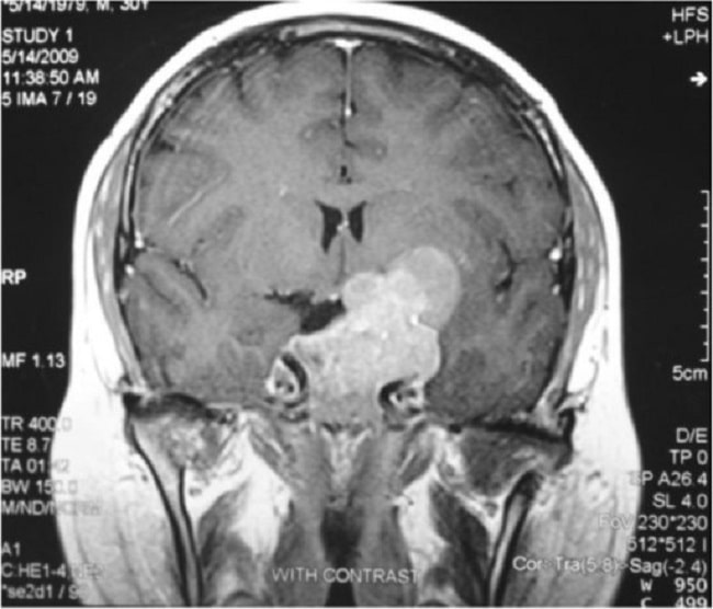 tumor, tumor hipofisis, tumor kelenjar, alomedika