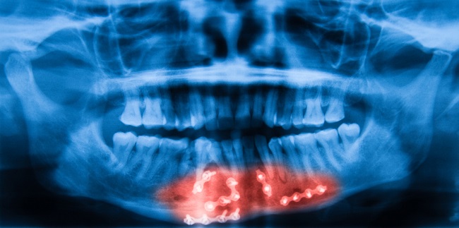 Panoramic,Radiography,Of,Mandible,Showing,Repaired,Fractures,Of,The,Mandible