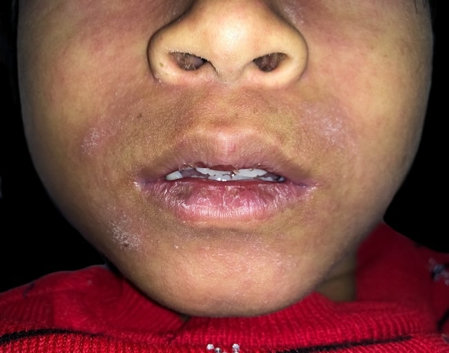 Xerostomia dan Sialolithiasis pada Pasien HIV