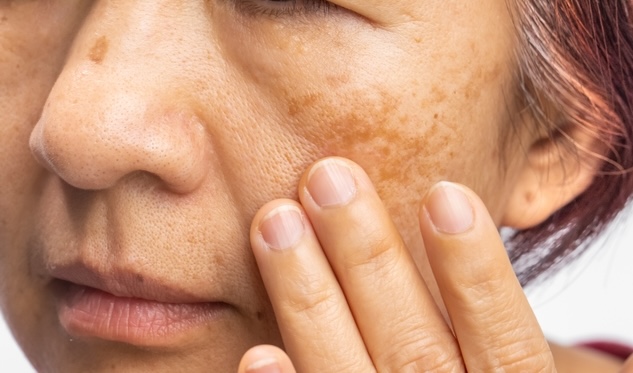 Terapi Topikal pada Melasma