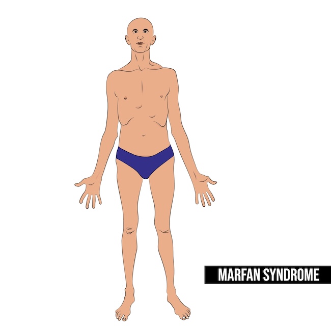 Kelainan Kardiovaskular pada Sindrom Marfan