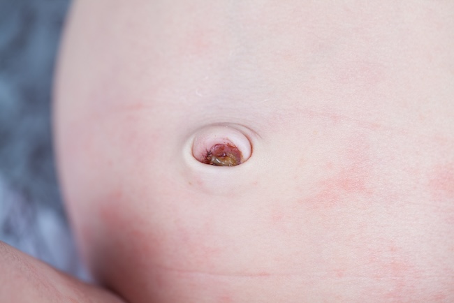 Garam Dapur untuk Manajemen Granuloma Umbilikalis