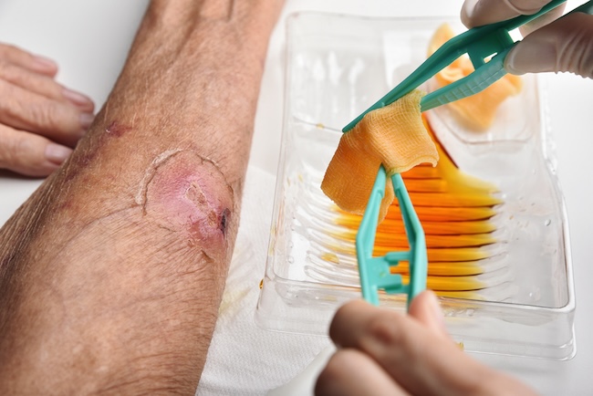 Peran Antiseptik Topikal dalam Penanganan Infeksi pada Luka Kronis