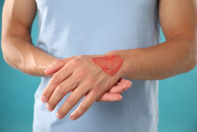 5 Cara Menghilangkan Bekas Luka Bakar yang Aman dan Efektif - Alodokter