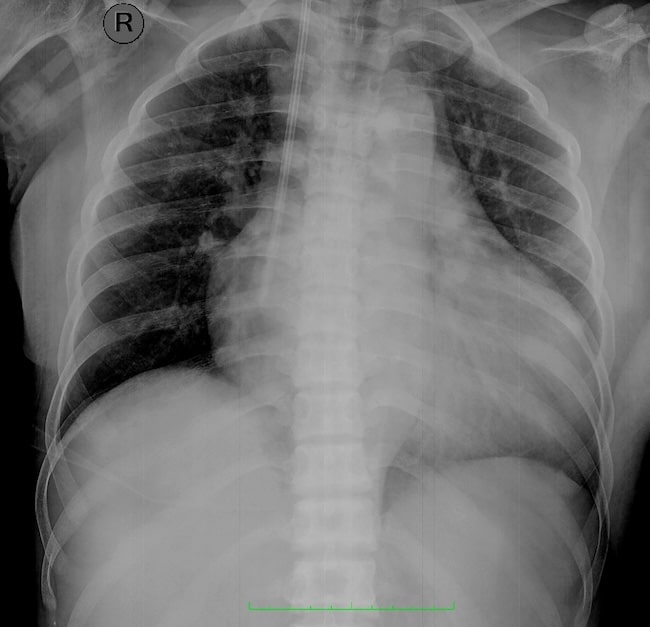 Pedoman Tata Laksana Gagal Jantung PERKI