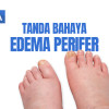 Video Alomedika - Red Flags Edema Perifer