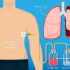 Penggunaan Chest Tube Drainage VS Aspirasi Jarum Pada Kasus Primary Spontaneous Pneumothorax