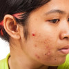 Gel Dapsone untuk Terapi Acne Vulgaris