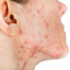 Pemberian Lactoferin Oral pada Terapi Acne Vulgaris