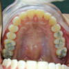 Toksisitas Restorasi Dental Amalgam