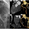 Pemeriksaan Coronary Computed Tomography Angiography untuk Nyeri Dada