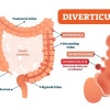 Kolonoskopi pada Divertikulitis Akut