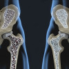 Teriparatide vs Risedronate untuk Osteoporosis Pencegahan Dan Terapi Osteoporosis Akibat Glukokortikoid – Telaah Jurnal Alomedika